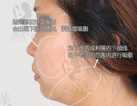 TS面部吸脂（脸颊下巴吸脂）的真实例子