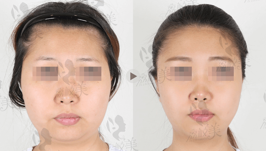 TS面部吸脂（脸颊下巴吸脂）的真实例子的手术前后