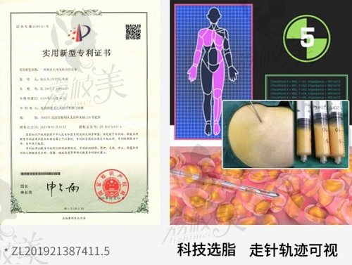 北京润美玉之光医疗美容王明利脂肪移植专有技术