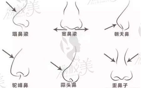 杭州薇琳盧建做鼻子技術(shù)好嗎？