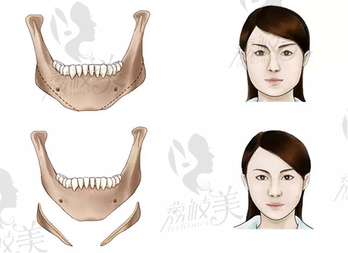 磨骨手术