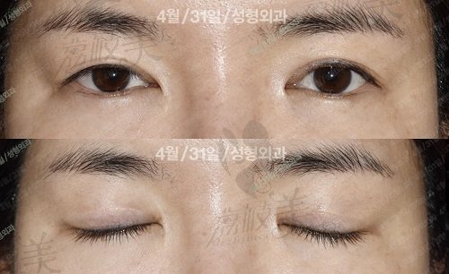 韩国431双眼皮修复前