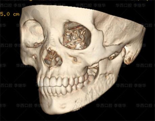 四川友誼醫(yī)院醫(yī)療美容下頜角CT