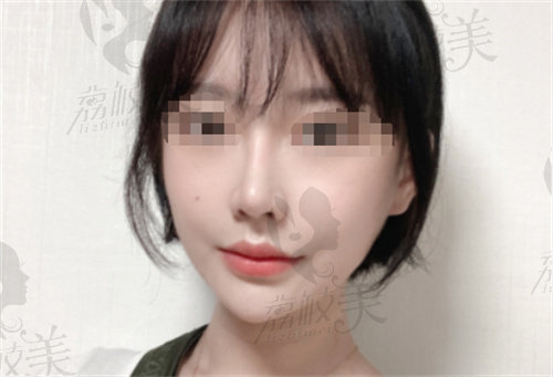 韩国欧佩拉整形外科医院隆鼻手术术后
