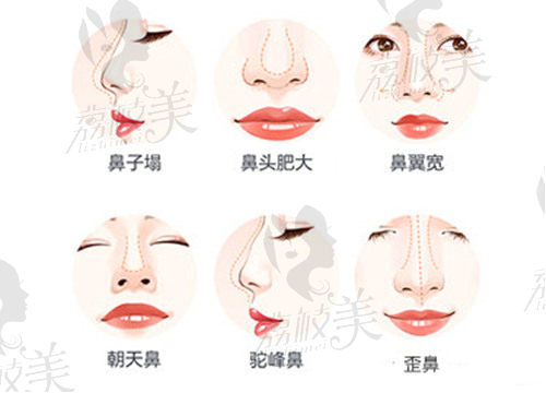 上海美莱美容整形隆鼻技术真不赖