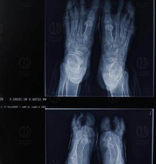 马桂文微创大脚骨手术后X光片