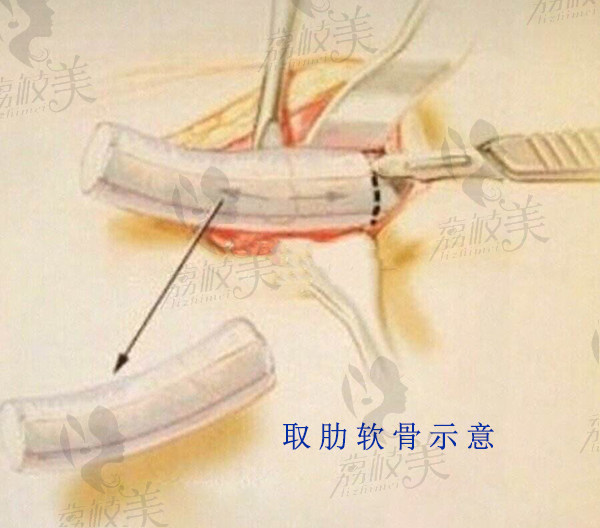 肋软骨取出示意