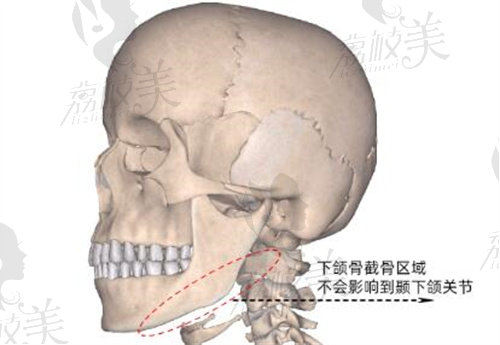 重庆华美潘宝华下颌角截骨