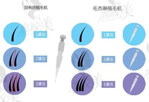 韓國(guó)毛杰琳整形醫(yī)院植毛機(jī)