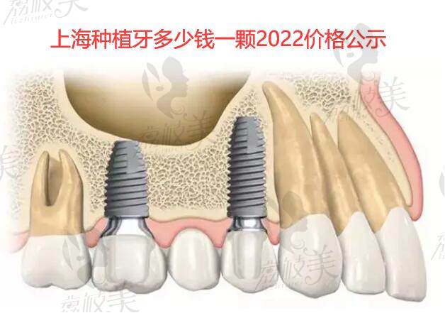 上海种植牙多少钱一颗2022价格表