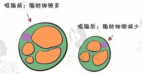 上海薇琳桑建波吸脂怎么样