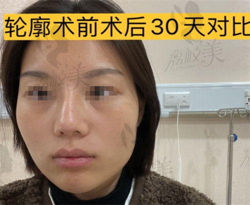 轮廓术前正面状态