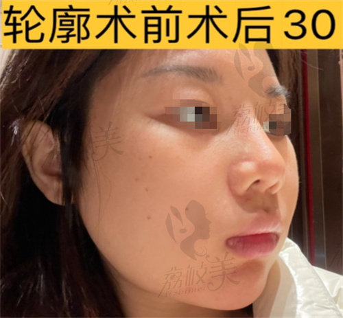 李继华轮廓恢复肿胀期