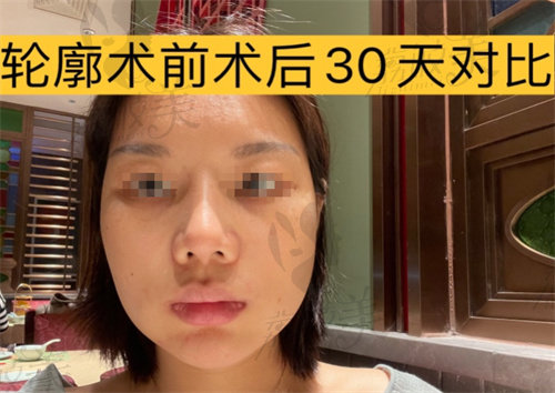 李继华轮廓恢复一个月
