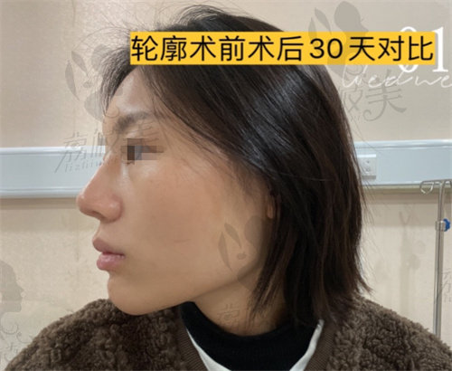 李继华轮廓术前侧面