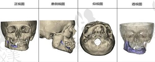 国内peek颅骨修补三维成像