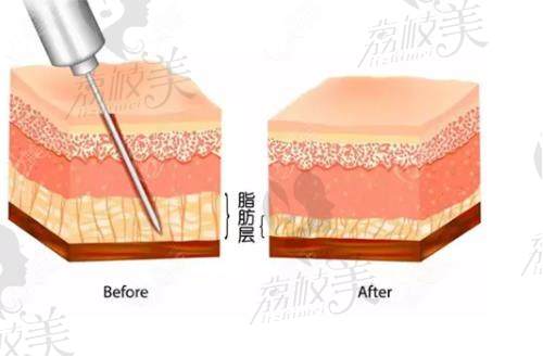 武漢仁愛時光醫(yī)療整形醫(yī)院脂肪層吸脂