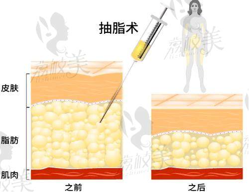 武汉仁爱时光医疗整形医院吸脂技术