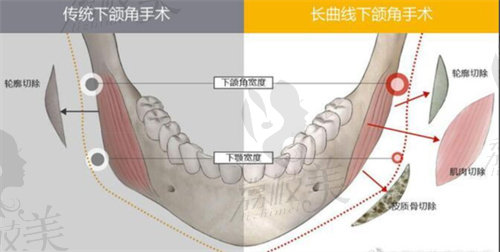 传统下颌角于长曲线下颌角对比