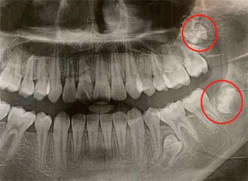 牙片中的智齿成像