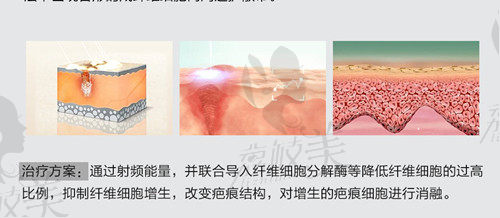 广州燕岭医院治疗疤痕