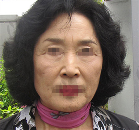 韩国欧佩拉整形拉皮手术亲身经历