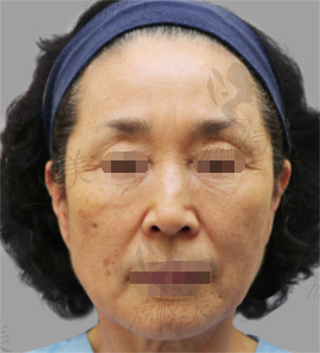 韩国欧佩拉整形拉皮手术实例