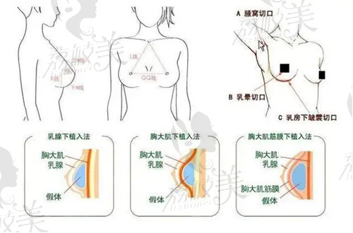 上海张建平隆胸技术好在哪