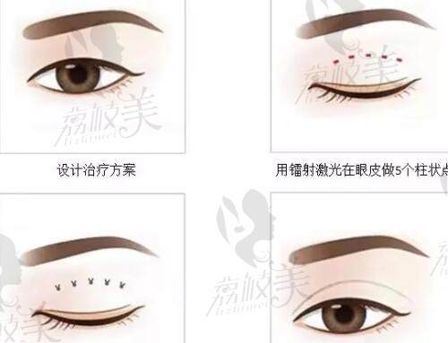 北京华臣医疗美容镭射定位双眼皮手术方式