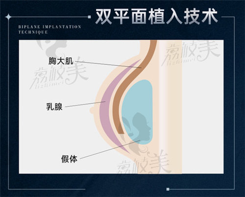 汪灏医生做假体隆胸价格参考公布