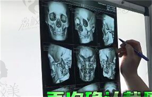重庆肖林颌面CT分析