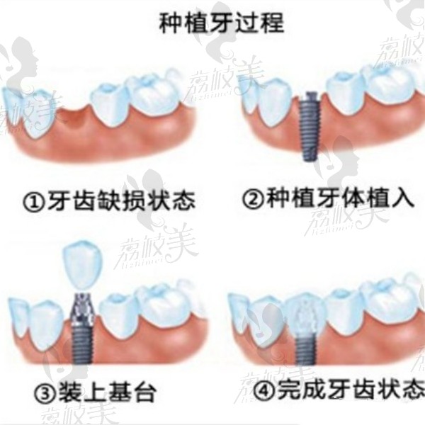 种植牙过程