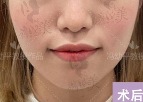武漢同濟馮幼平吸脂怎么樣 武漢同濟馮幼平吸脂怎么樣