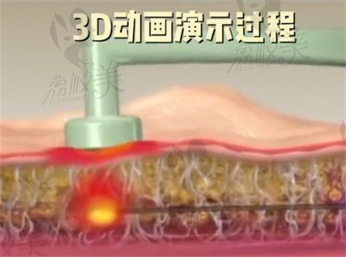 3D动画演示吸脂过程