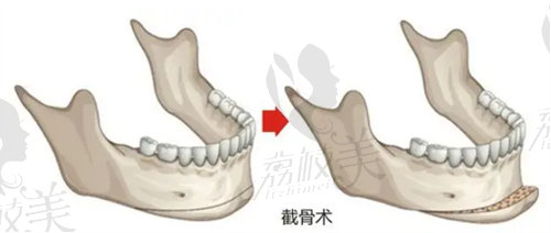 西安磨骨醫(yī)生推薦