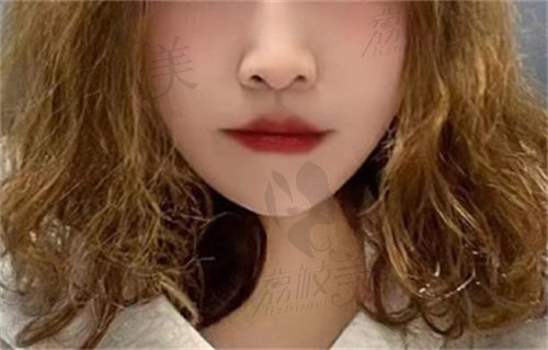 罗恩下颌角术后1年多