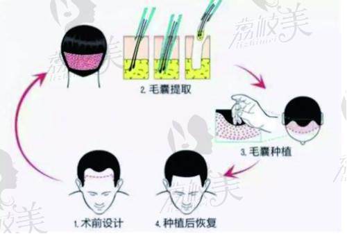苏州名仕医院植发中心植发过程