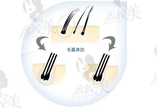苏州名仕医院植发中心毛囊提取