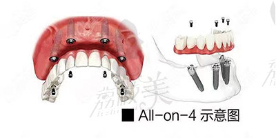 All-on-4种植技术