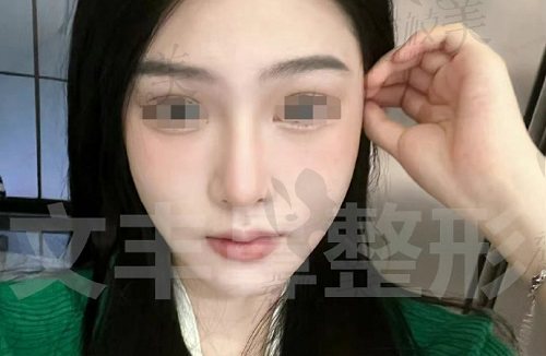 深圳艺星医疗美容医院鼻部整形技术