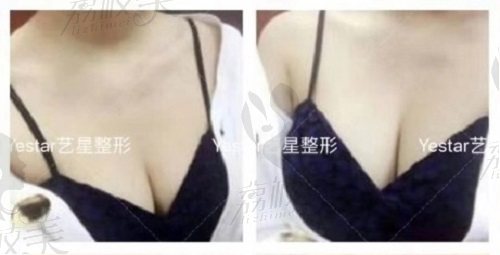 深圳艺星医疗美容医院胸部整形技术