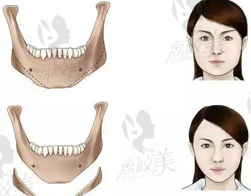 下颌角手术