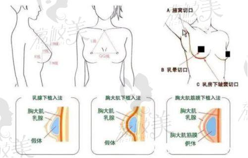 汪灏医生隆胸手术方法