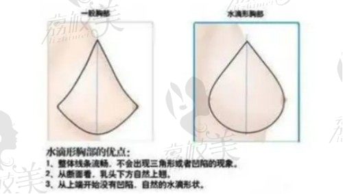 汪灏医生隆胸技术好