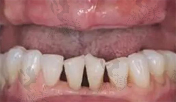 半口种植牙术前图片