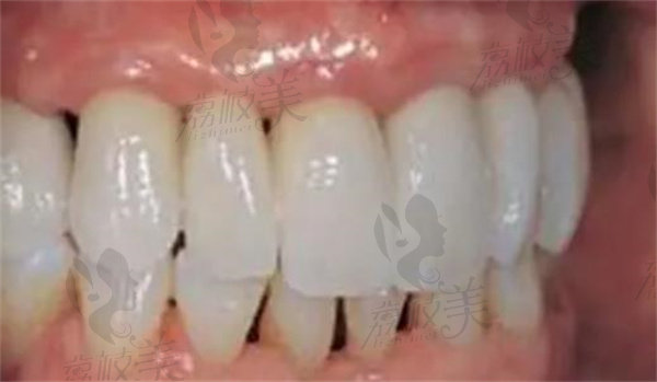 半口种植牙术后图片