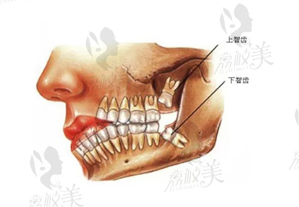 拔智齿多少钱一颗