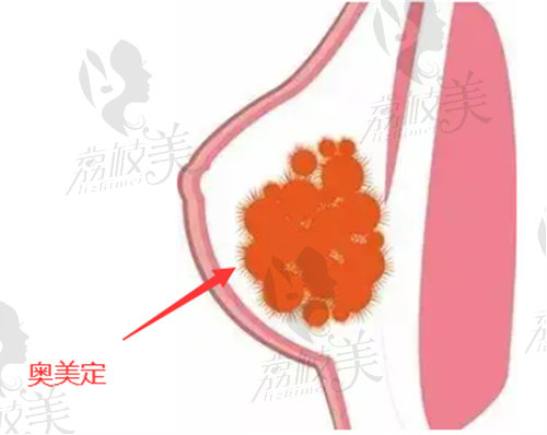 西安取奥美定干净的医院