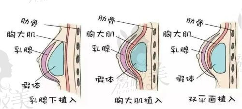 包涛医生假体隆胸技术好