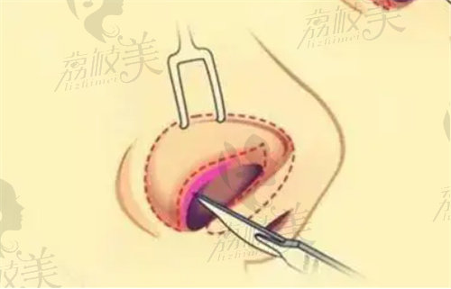 上海鼻头缩小整形医院哪家好